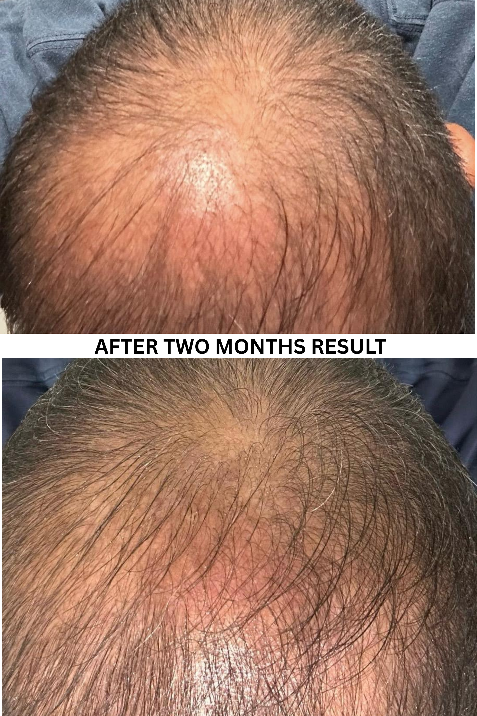 Before and after comparison of hair growth after two months of use with natural hair growth oil made with natural botanical ingredients chemical free.