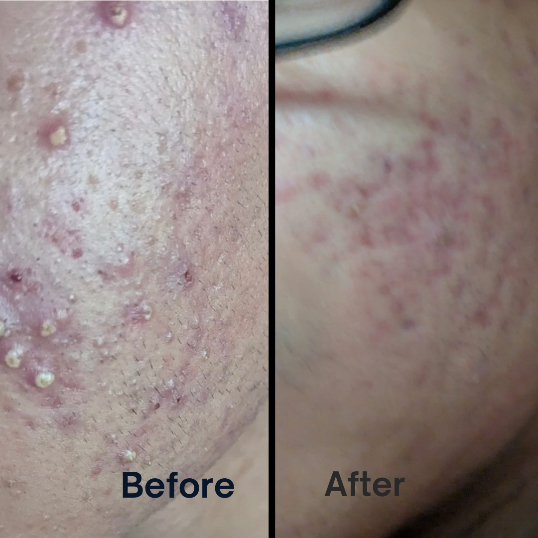 Organic Acne & Scar Repair Cream