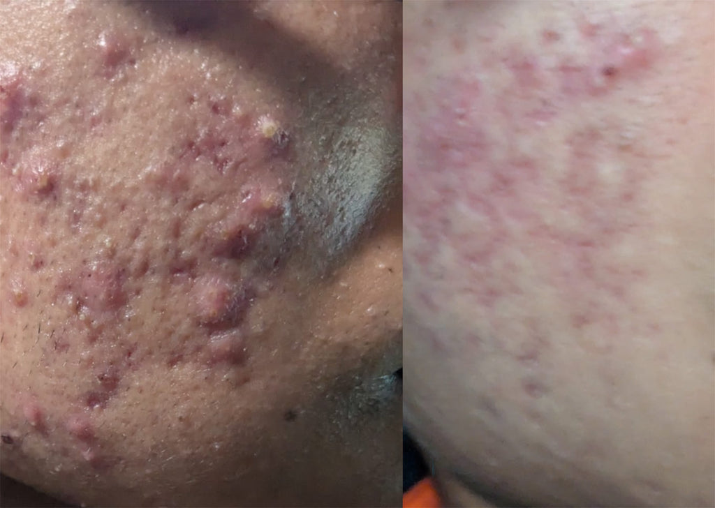 Organic Acne & Scar Repair Cream