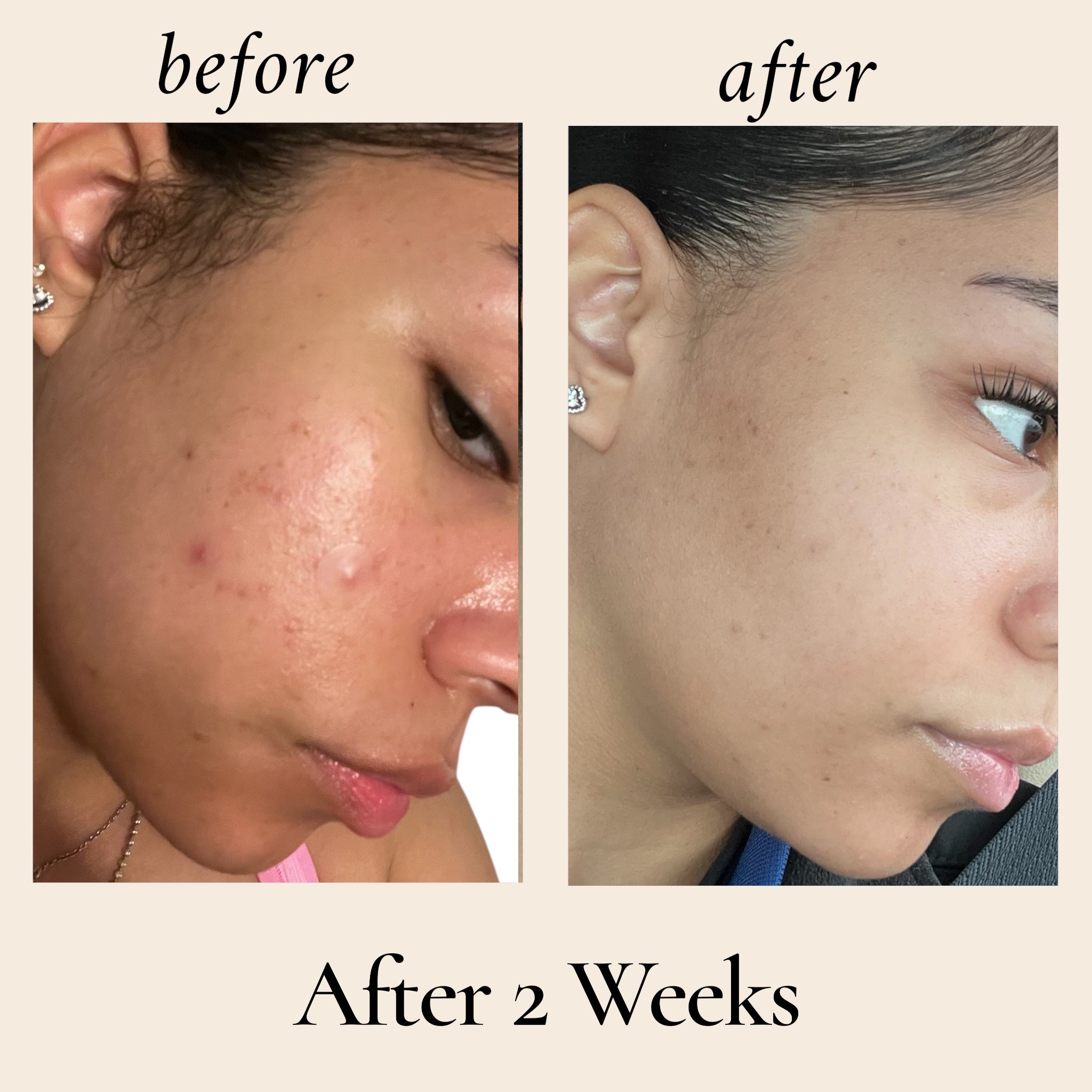 Before and after comparison of a person's face with acne, showing improvement after 2 weeks.all natural  organic ingredients no chemicals or preservatives.